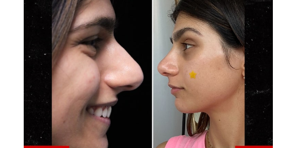 Mia Khalifa realiza cirurgia plástica e limpa o nariz; ver antes e depois - 27/06/2020